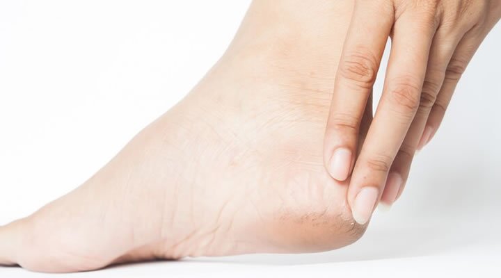 9 Doenças comuns que afetam os pés e descubra como evitá-las 1 doenças comuns que afetam os pés