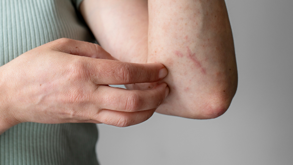 Como evitar alergia com roupas? 2 Alergia suar
